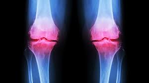 Osteoarthritis