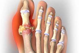 Gouty Arthritis