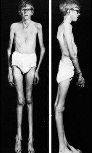 Marfan Syndrome, and 10 Famous People with It – My Info Connect